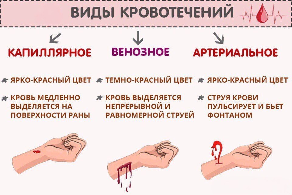 виды кровотечений