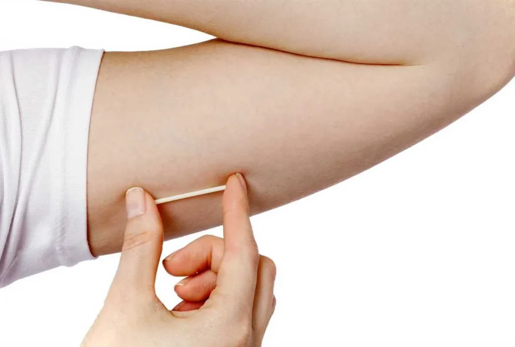 гормональный имплантат, импланон