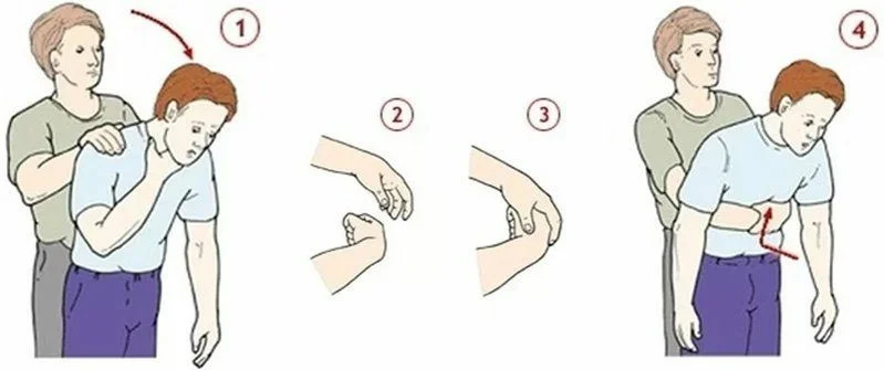 прием Геймлиха