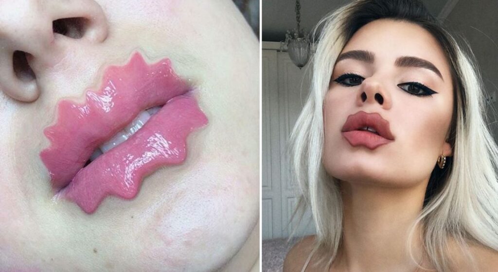 дьявольские губы, губы Брауде, странные губы