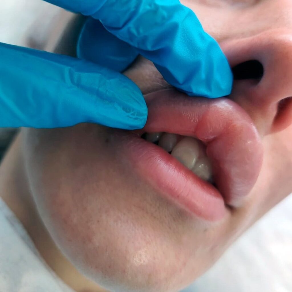 неправильное увеличение губ, последствия после контурной пластики губ