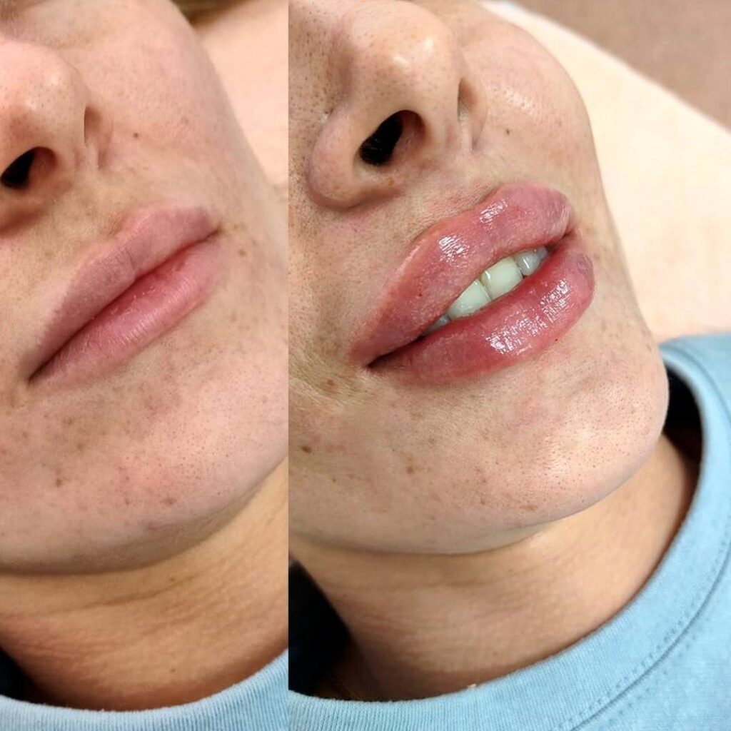 увеличение губ, классическое увеличение губ