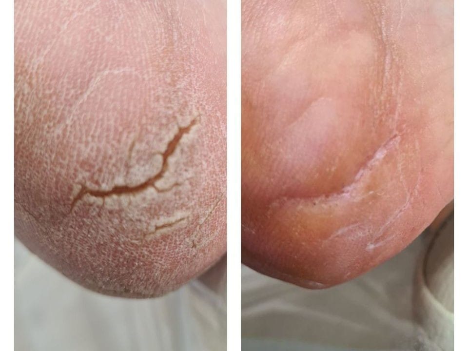 диабетическая стопа, трещина на пятке