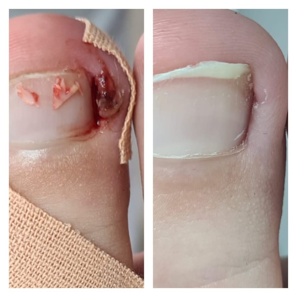 вросший ноготь, удаление вросшего ногтя