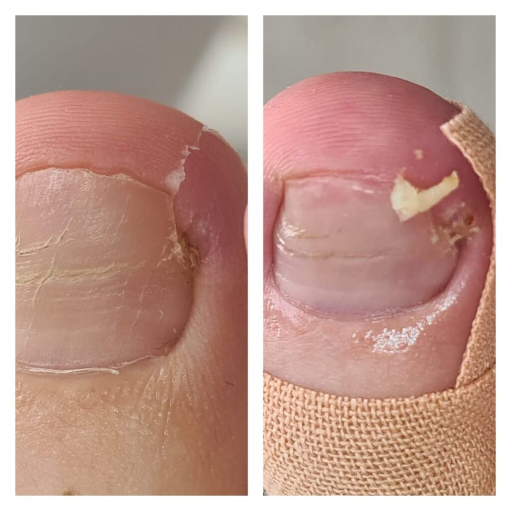 вросший ноготь, удаление вросшего ногтя