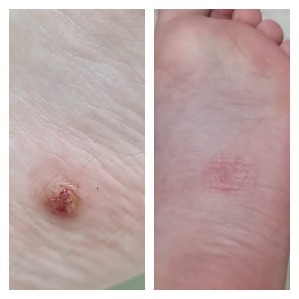 удаление бородавки, как удалить бородавку