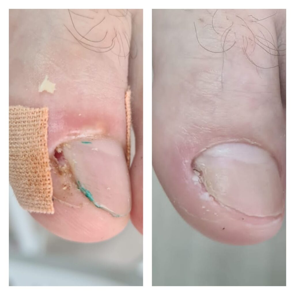 вросший ноготь, удаление вросшего ногтя