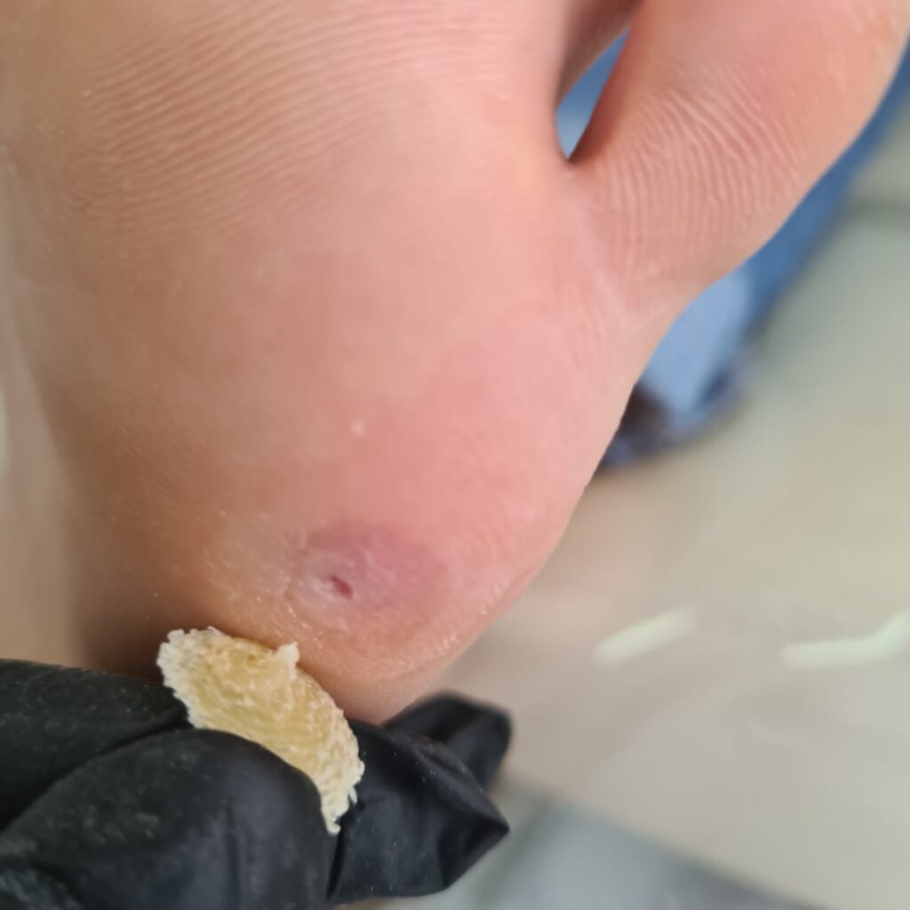 стержневая мозоль, удаление стержневой мозоли