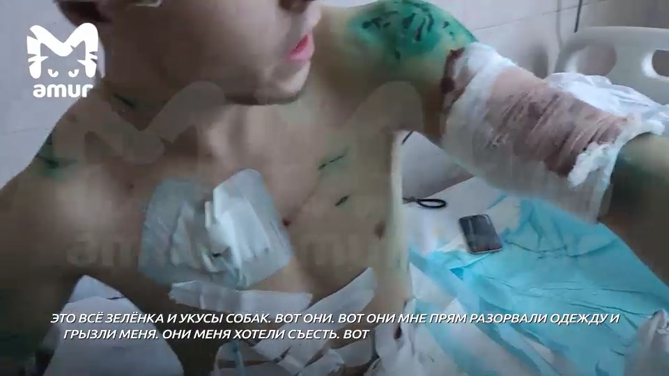 «Они меня хотели съесть, сняли скальп»: хабаровчанин, на которого напали собаки, очнулся и показал страшные раны