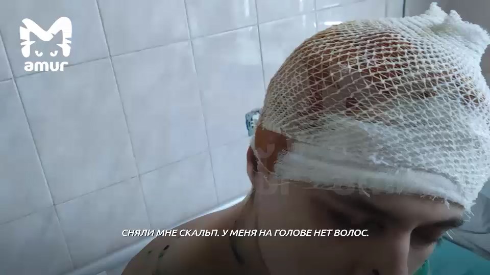 «Они меня хотели съесть, сняли скальп»: хабаровчанин, на которого напали собаки, очнулся и показал страшные раны