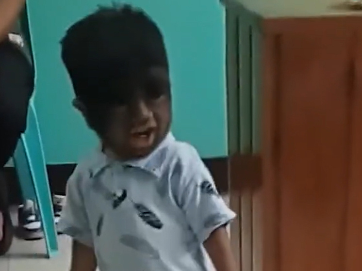 На Филиппинах женщина родила ребёнка с «синдромом оборотня» из-за кошки