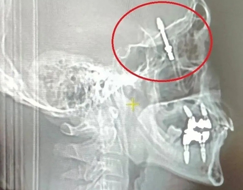 В Турции стоматолог просверлил мозг пациенту, пытаясь поставить имплант