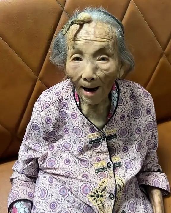 У 107-летней жительницы Китая на лбу вырос 10-сантиметровый рог 