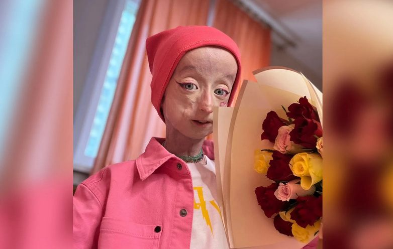 Девочке-эльфу из Новосибирска отказали в операции из-за преждевременного старения