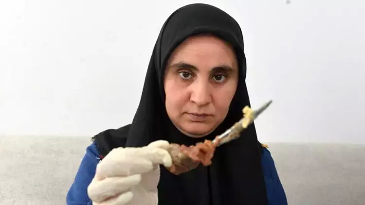 Жительница Турции семь лет прожила с ножницами в животе