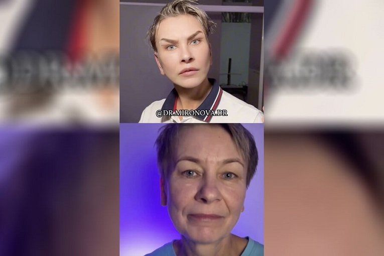 Пенсионерка сделала пластику лица, чтобы стать похожей на певца SHAMAN