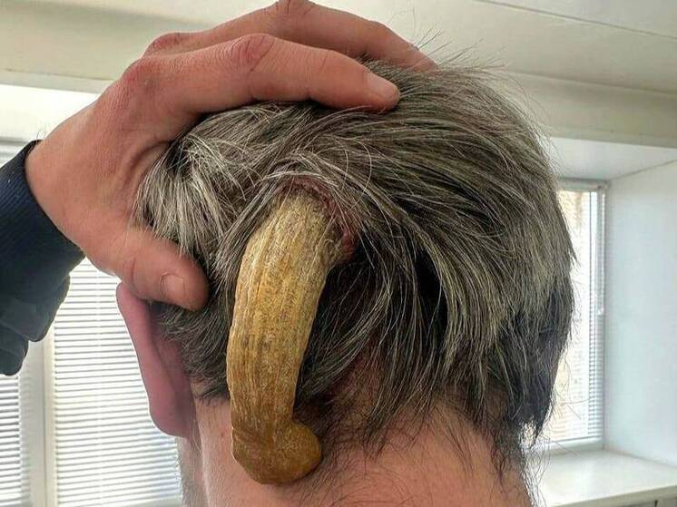 Гигантский «дьявольский рог» удалили 30-летнему жителю Набережных Челнов