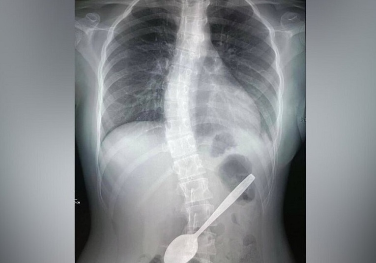 Врачи извлекли 15-сантиметровую ложку из желудка девочки