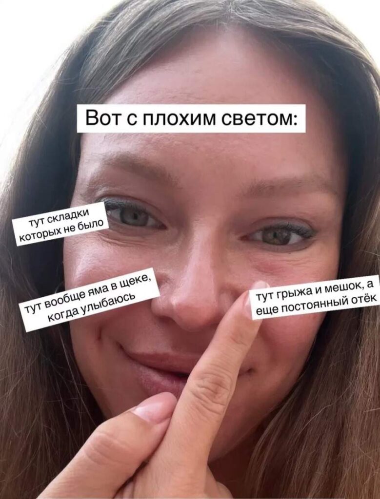 Рита Дакота показала результат неудачной пластики лица