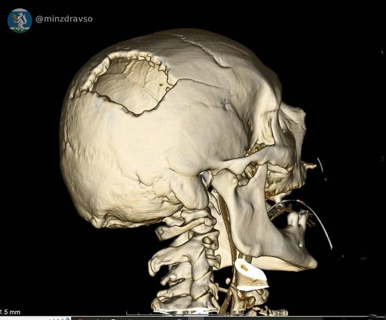 Уральские врачи спасли мужчину с расколотым черепом после удара стрелы крана