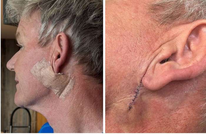 Шеф-повар Гордон Рамзи показал фото после операции из-за рака кожи