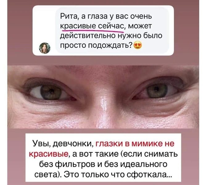 Рита Дакота показала фото после неудачной пластики век