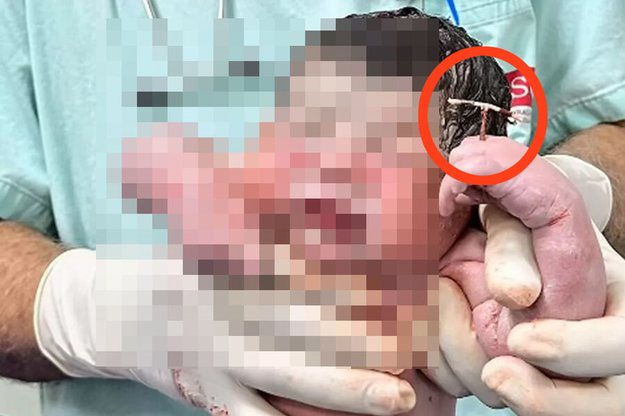 В Бразилии младенец родился с внутриматочной спиралью в руке