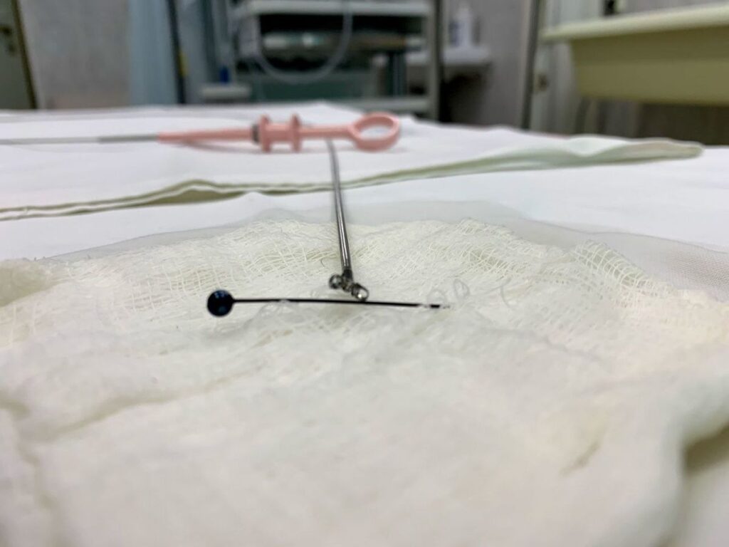 Врачи спасли мужчину, выпившего рюмку водки с иголкой