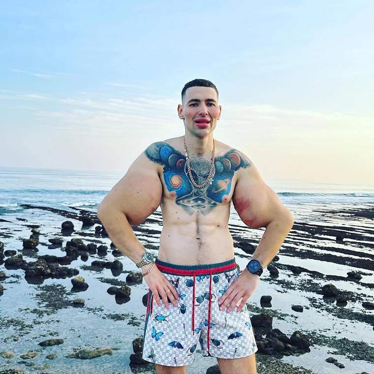 Трэш-блогеру Кириллу Терёшину грозит ампутация рук