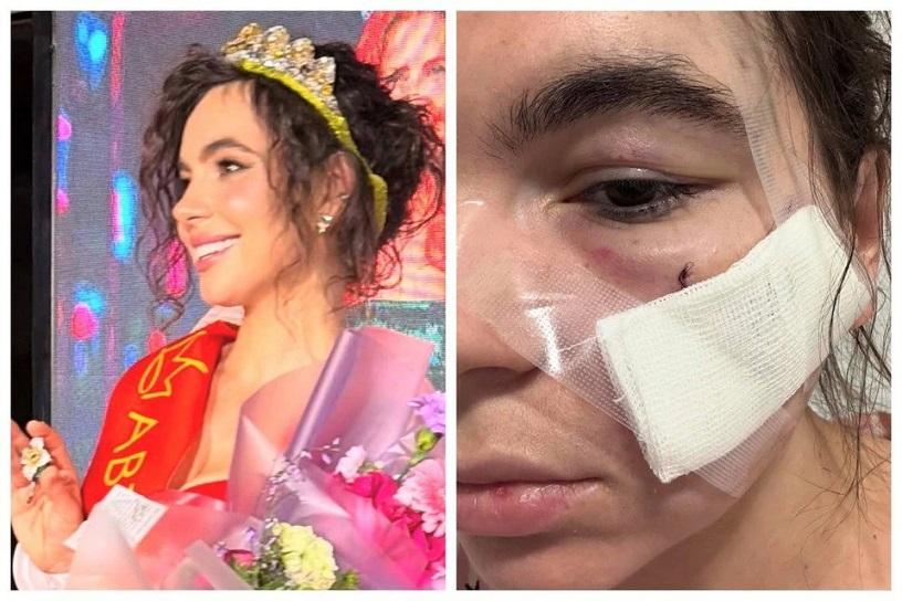 Королеве красоты из Кирова изуродовали лицо в казанском клубе