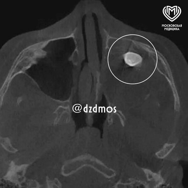 Врачи в Москве удалили подростку зуб, выросший в носу
