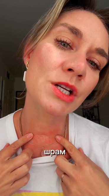 Мария Машкова рассказала, что перенесла операцию из-за рака щитовидной железы